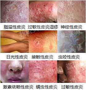 广州肤康皮肤病医院